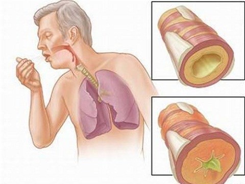 Những triệu chứng phổ biến của ung thư phổi - Ảnh 1