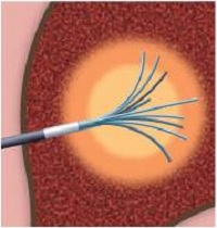 Minh họa hoạt động sinh nhiệt của kim đốt trong khối u